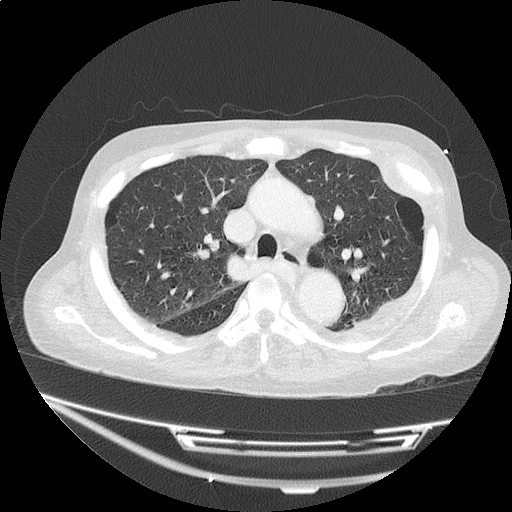 ct_chest_anemia_09